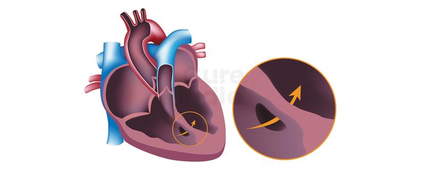  اغلاق عيب الحاجز البطيني والأذيني (ASD,VSD Closure)